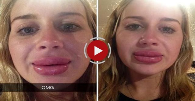 Lip Enhancer Fail