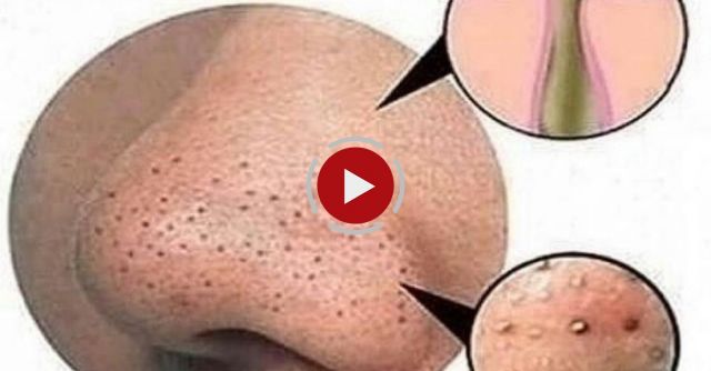 How To Remove Blackheads From Nose