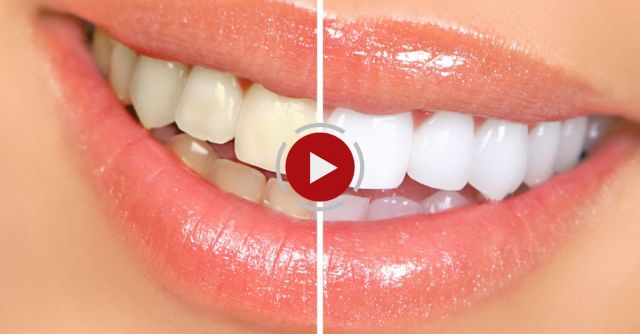 Brilliant Tip To WHITEN Your Teeth At Home For Little Cost