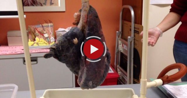 Smokers Lungs .vs Healthy Lungs