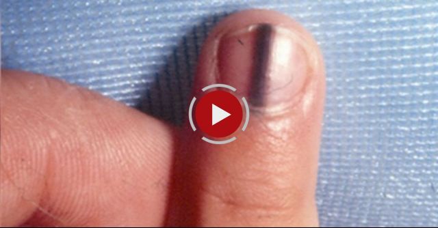 Potentiall Deadly Form Of Nail Cancer