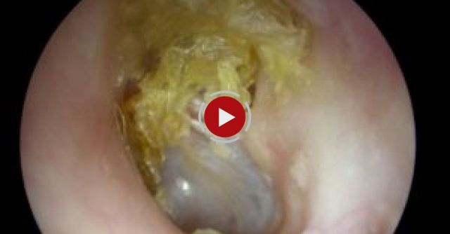 People Get Earwax Extractions For The First Time