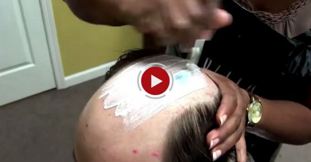 Non-Surgical Hair Replacement 