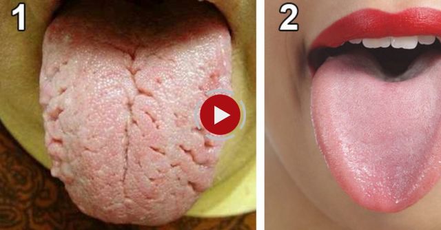 What Your Tongue Says About Your Health