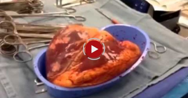 Gruesome Video Shows Dangers Of Cocaine Abuse On Heart 