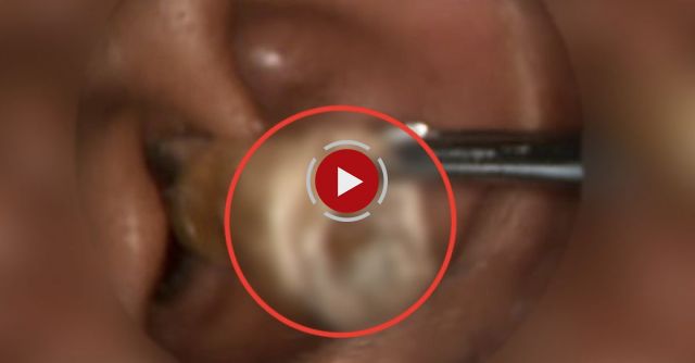 The Moulded Ear Impacted Wax