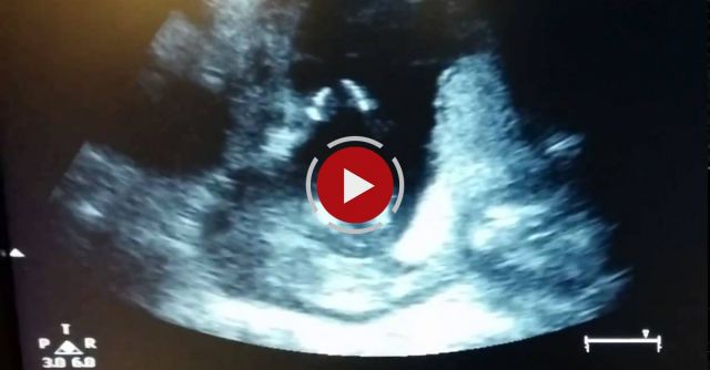 Ultrasound Shows Baby Clapping 