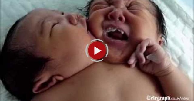 Amazing Conjoined Twins Born In China