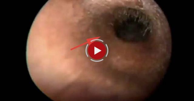 Removal Cockroach's Bodies From Ears Canal.