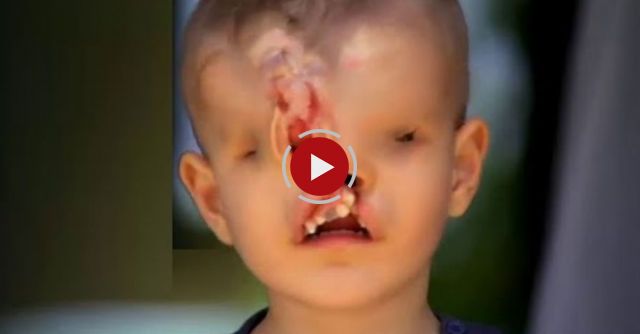 Born Without A Face - Saved By An Angel