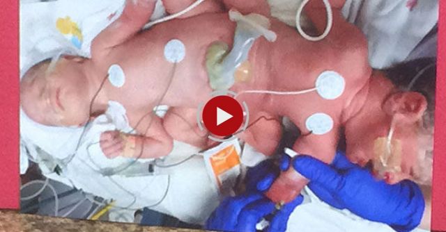 Conjoined Twins Born From Set Of Identical Triplets 