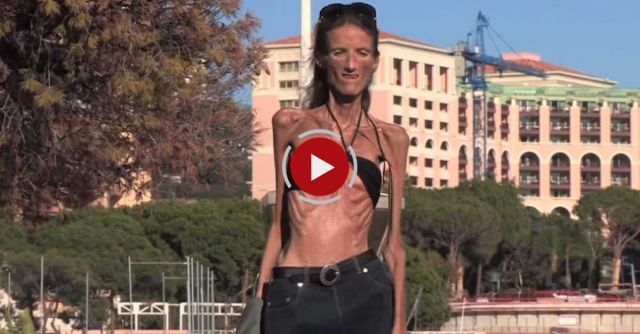 Extreme Anorexic Speaks Out About The Eating Disorder
