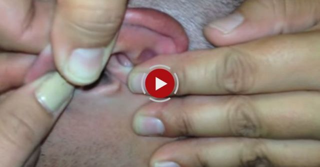 Bug Buried In Guy’s Ear