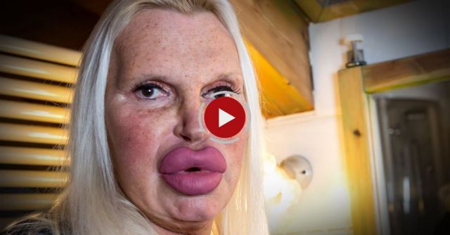 Surgery Obsessive Spends $76,000 In Quest For Perfection