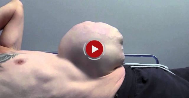 Surgeons Use New Technique To Fix Hernia The Size Of A Football