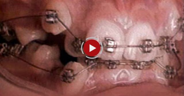 Straight Teeth In Under 60 Seconds!