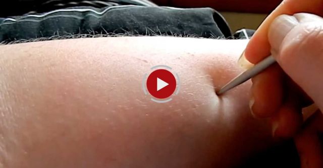 Rare Condition Allows Woman To Draw On Her Skin Without Ink