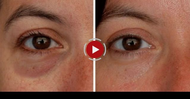 How To Make Eye Bags Vanish