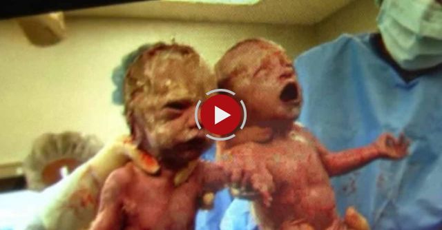 Mother Gives Birth To Rare Twins Holding Hands
