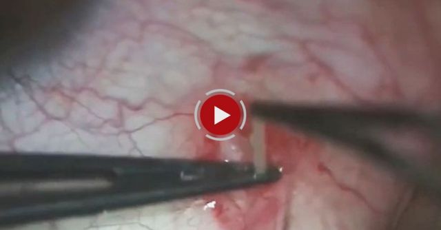 Giant Parasitic Worm Pulled From Man's Eye In Gruesome Surgery Video That's Not For The Faint Hearte