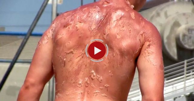 Peeling Sunburn Prank