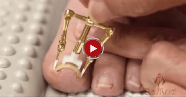 I Dare You Not To Cringe Watching This Person Fix An Ingrown Toenail