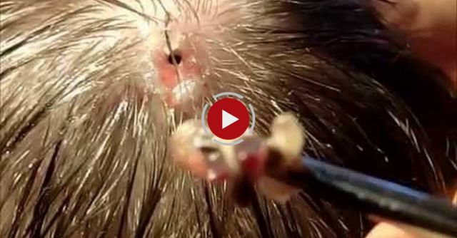 Huge Botfly Maggot Removed From Head