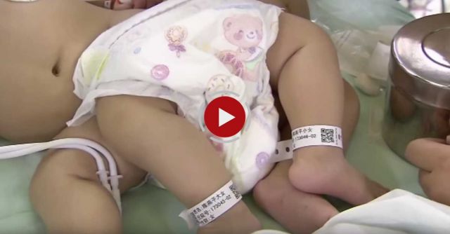 Chinese Conjoined Twins Separated With 3D Technology