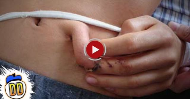 15 People With Extra Limbs & Body Parts