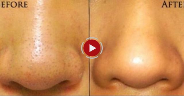 How To: Minimize Pores With Baking Soda!