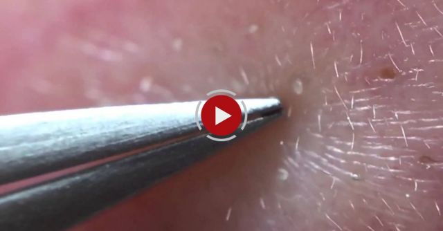 Pull Out The Nose Blackheads