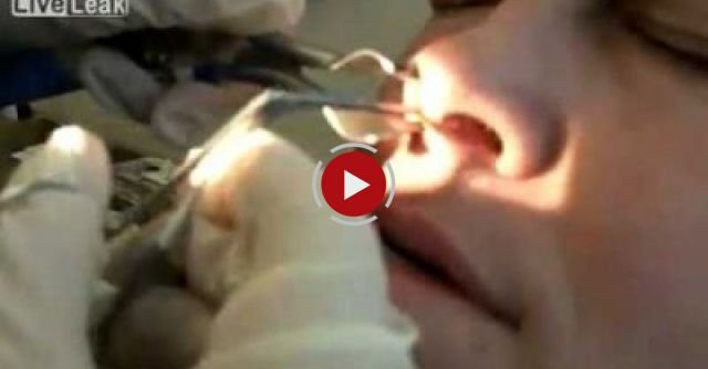 Doctor Removes Booger From Hell From Inside Man's Nose