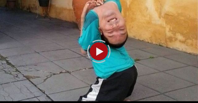 Claudio Vieira De Oliveira With Arthrogryposis