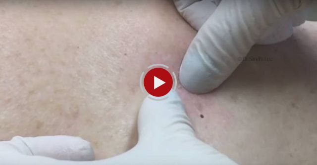 The Return Of The Original Big Back Blackheads
