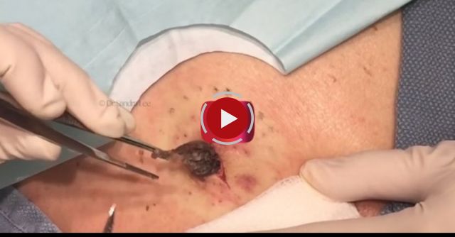 Large Epidermoid Cyst Excised On The Back